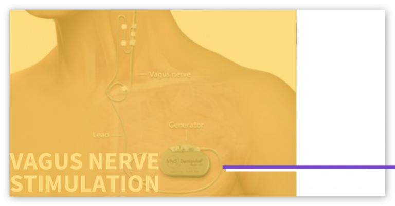 What Is Vagus Nerve Stimulation Vns Webshrink