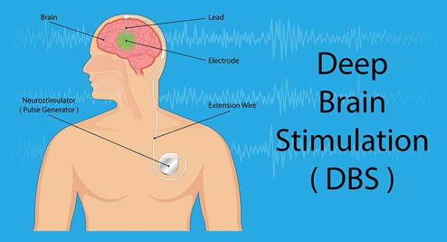 deep brain stimulation