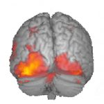 anorexia brain