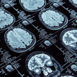 alzheimer's drug